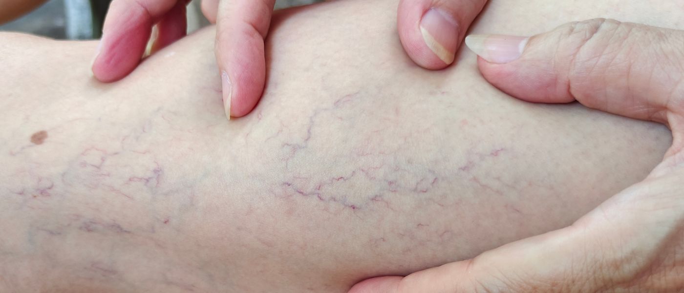 Water in the Legs » Causes, Signs & Tips!